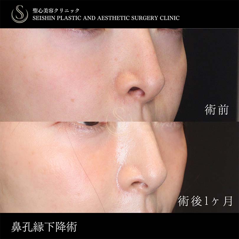 【30代女性・鼻孔縁下降術で鼻の穴を目立ちにくく】鼻孔縁下降術（術後1ヶ月） Before 