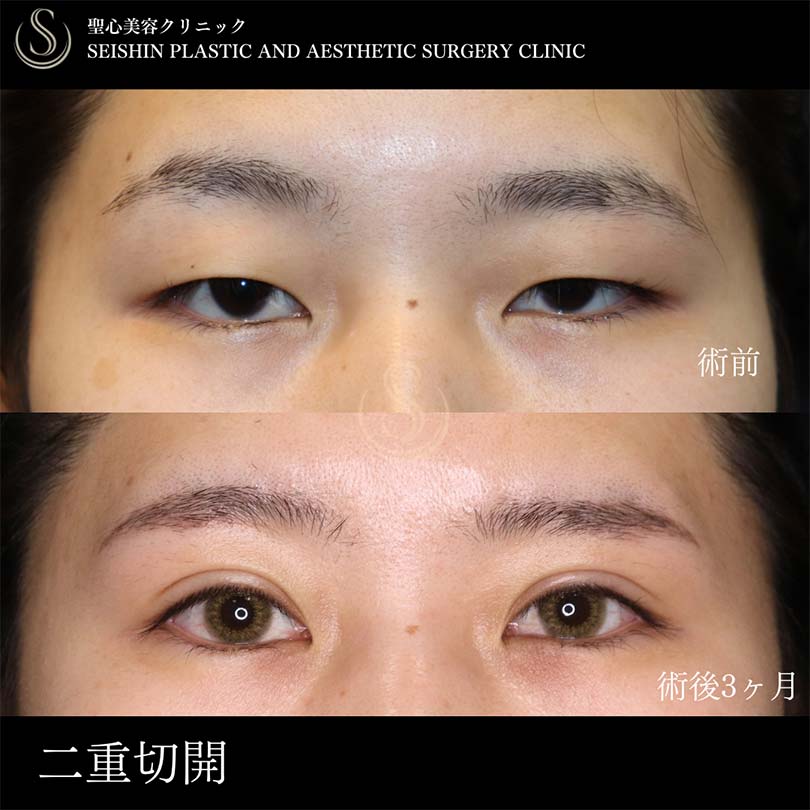 【20代女性・二重切開で目の開きを改善】二重術（切開法）部分切開/全切開（術後3ヶ月） Before 