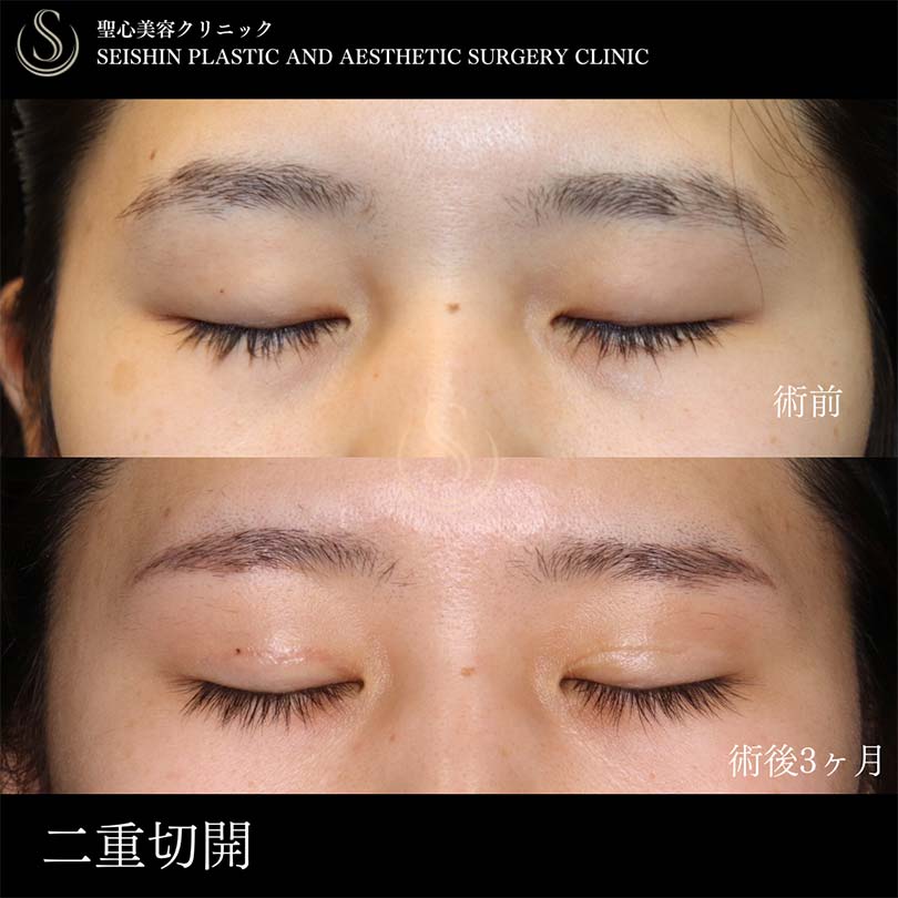 【20代女性・二重切開で目の開きを改善】二重術（切開法）部分切開/全切開（術後3ヶ月） After 