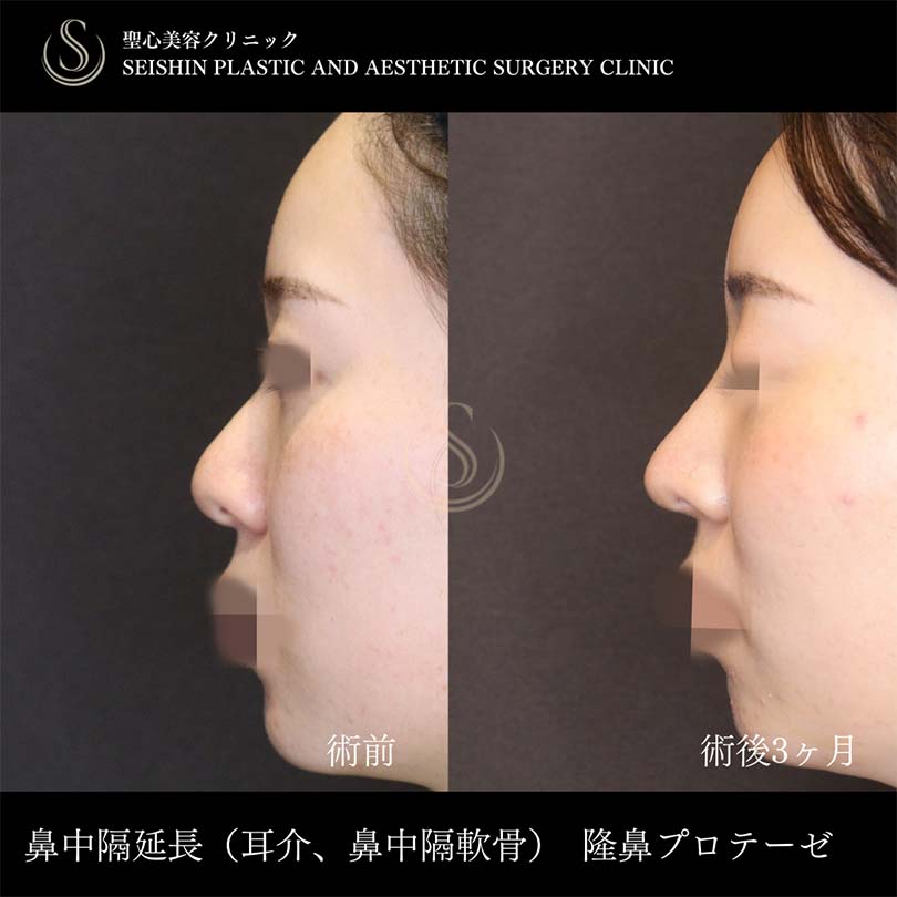【20代女性・鼻先を高く、ツンとさせるには鼻中隔延長】鼻中隔延長術、プロテーゼによる隆鼻術、鼻尖形成（耳介軟骨移植）（術後3ヶ月） Before 