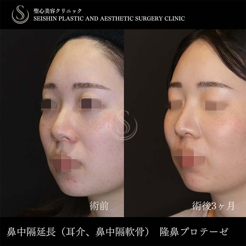 【20代女性・鼻先を高く、ツンとさせるには鼻中隔延長】鼻中隔延長術、プロテーゼによる隆鼻術、鼻尖形成（耳介軟骨移植）（術後3ヶ月） After 