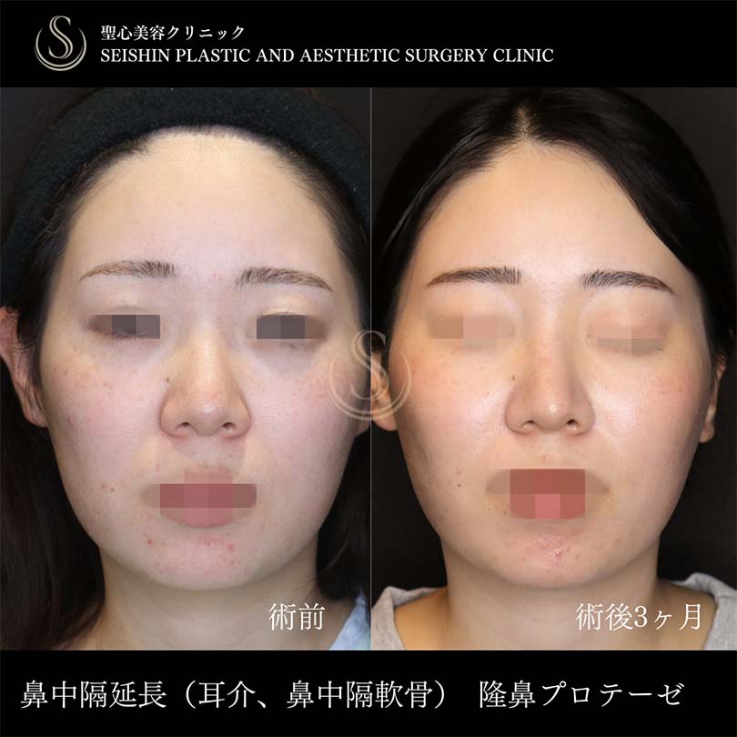 【20代女性・鼻先を高く、ツンとさせるには鼻中隔延長】鼻中隔延長術、プロテーゼによる隆鼻術、鼻尖形成（耳介軟骨移植）（術後3ヶ月） After 