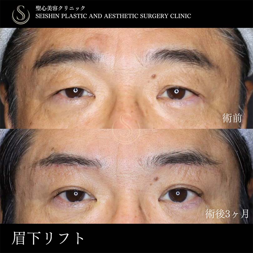 【60代男性・眉下リフトで目元すっきり】眉下切開法（眉下リフト）（術後3ヶ月） Before 