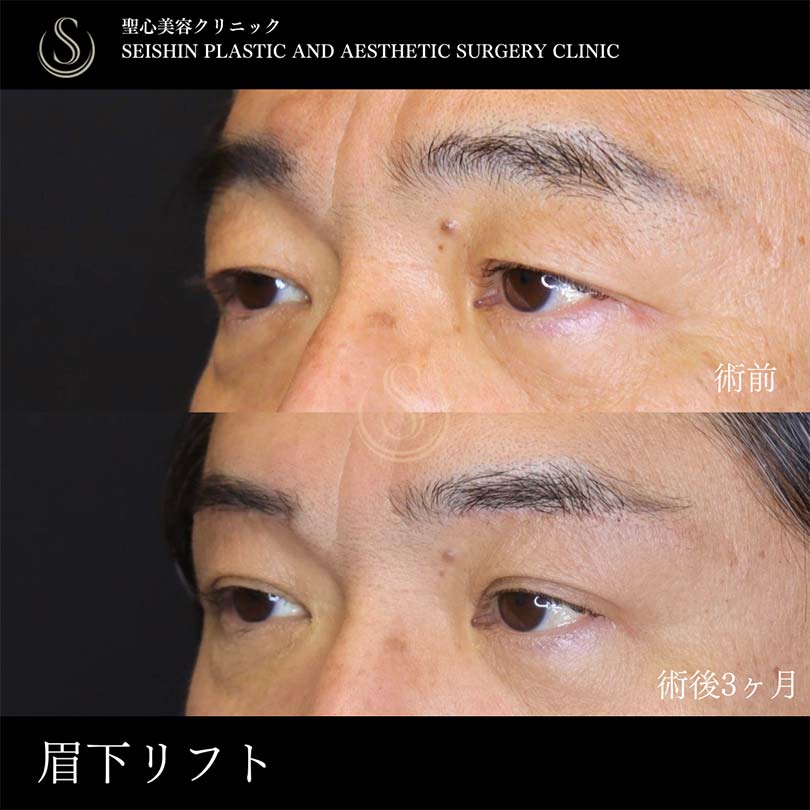 【60代男性・眉下リフトで目元すっきり】眉下切開法（眉下リフト）（術後3ヶ月） After 