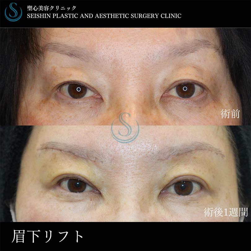 【50代女性・眉下切開で二重幅を広げて目元スッキリ】眉下切開法（眉下リフト）（術後1週間） After 