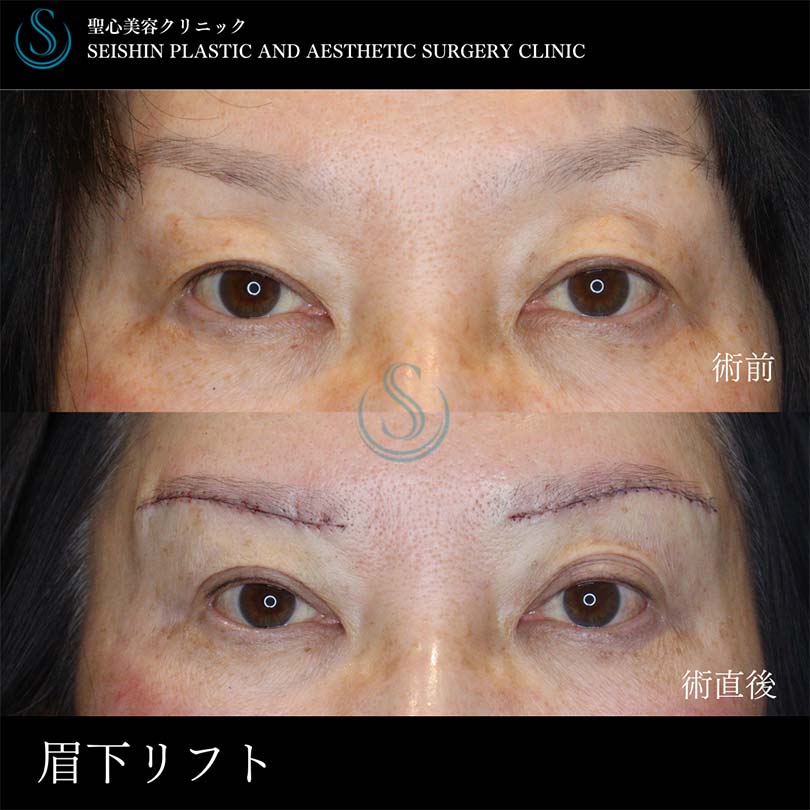 【50代女性・眉下切開で二重幅を広げて目元スッキリ】眉下切開法（眉下リフト）（術後1週間） After 