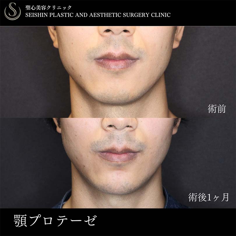 【20代男性・顎プロテーゼでEラインを整える】あごプロテーゼ（術後1ヶ月） After 