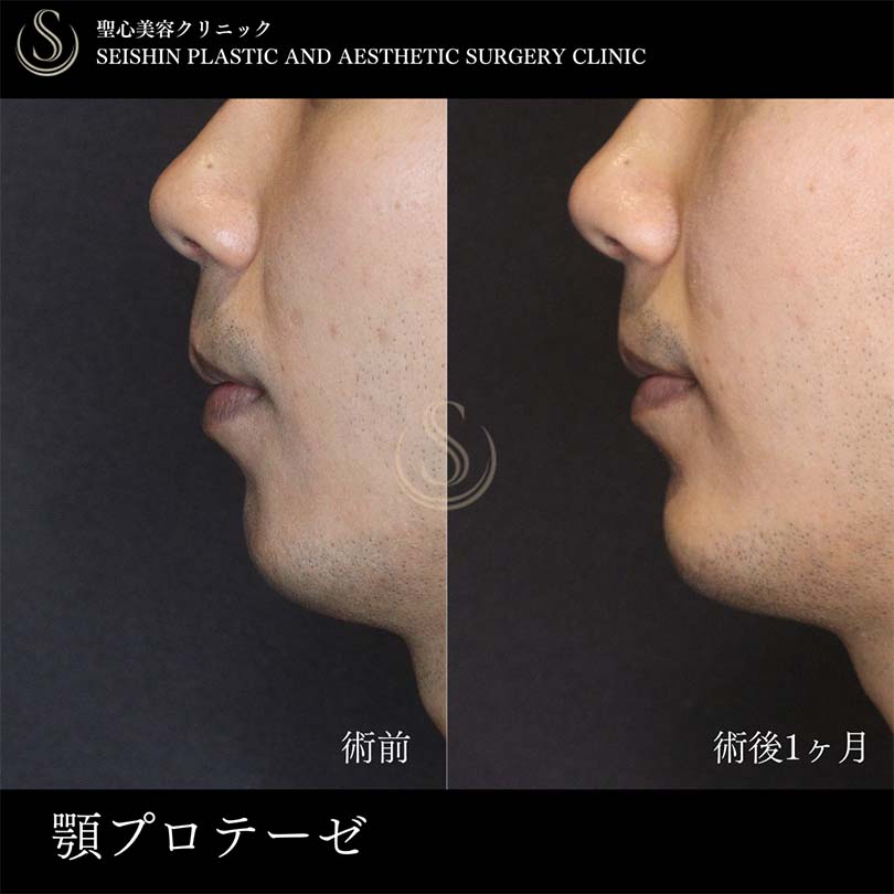 【20代男性・顎プロテーゼでEラインを整える】あごプロテーゼ（術後1ヶ月） Before 