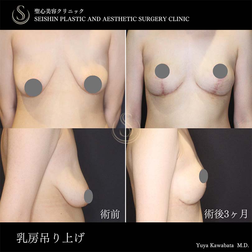 【20代女性・ダイエットで垂れたお胸の形を吊り上げで整える】乳房吊り上げ術・乳輪吊り上げ術（術後3ヶ月） Before 