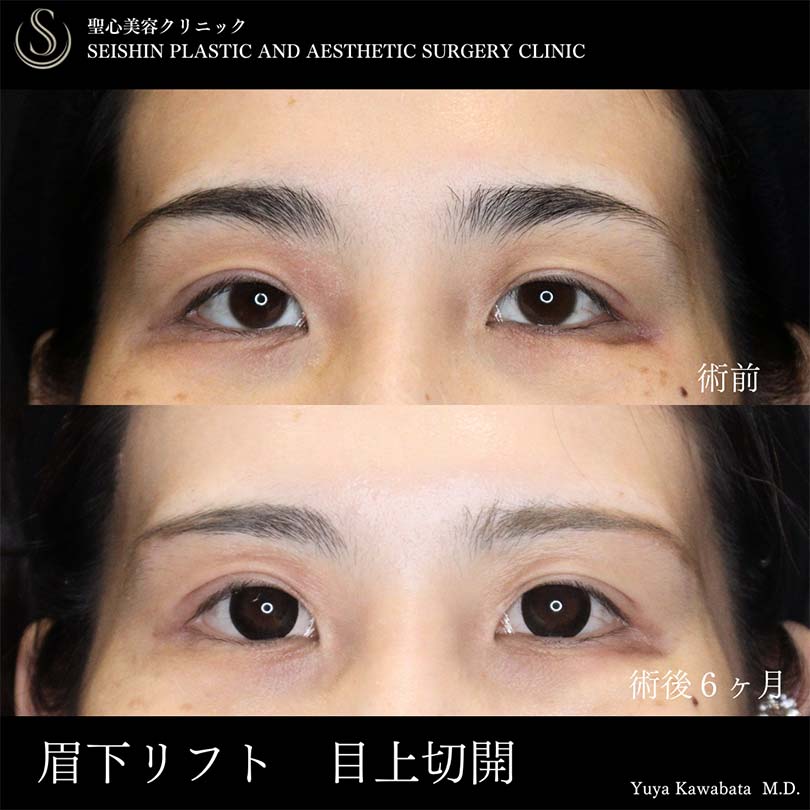 【20代女性・眉下リフトと目上切開で目の開きを改善し平行二重に】眉下切開法（眉下リフト）、目上切開（術後6ヶ月） Before 