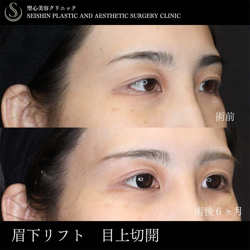 【20代女性・眉下リフトと目上切開で目の開きを改善し平行二重に】眉下切開法（眉下リフト）、目上切開（術後6ヶ月） After 