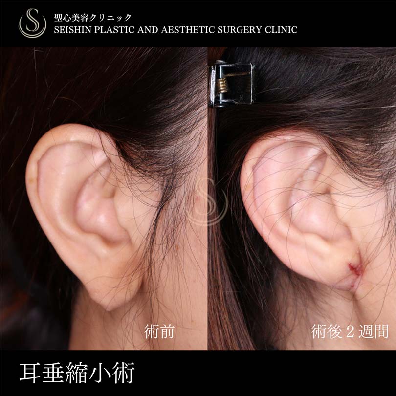 【40代女性・耳垂縮小で耳たぶをスッキリ】 耳たぶ修正（術後2週間） Before 