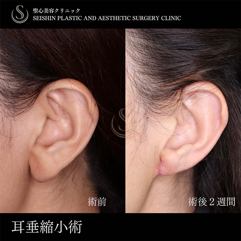 【40代女性・耳垂縮小で耳たぶをスッキリ】 耳たぶ修正（術後2週間） After 