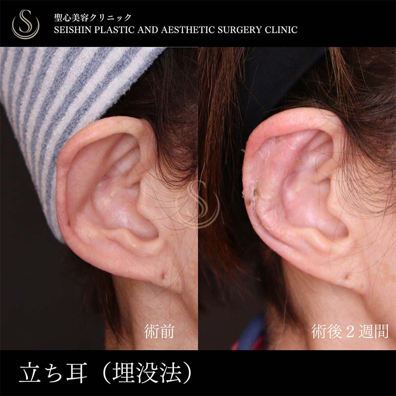 【60代女性・立ち耳を糸で改善】立ち耳修正（埋没法）（術後2週間） After 