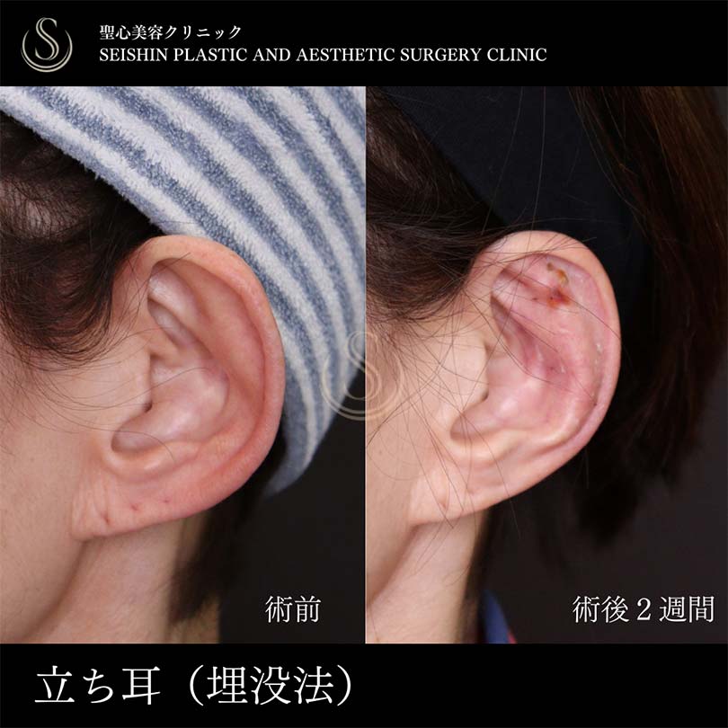 【60代女性・立ち耳を糸で改善】立ち耳修正（埋没法）（術後2週間） After 