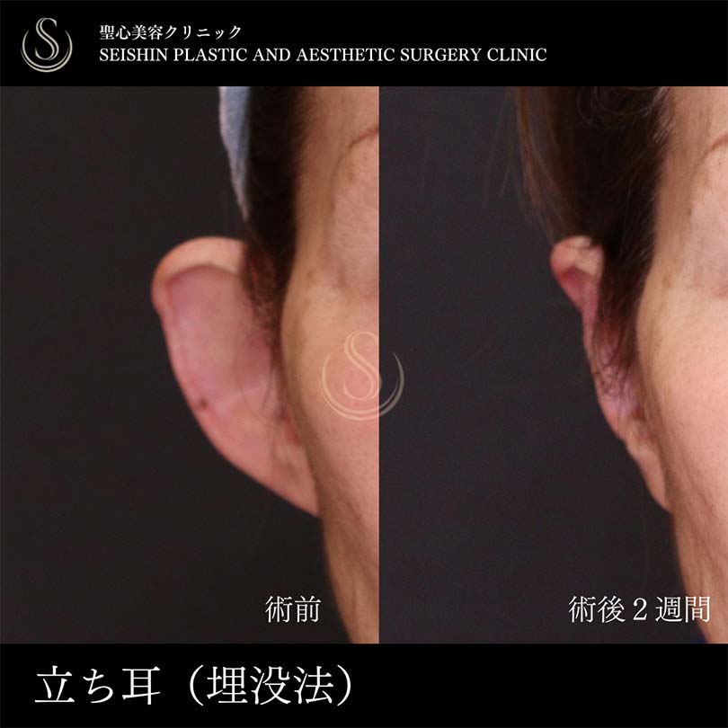 【60代女性・立ち耳を糸で改善】立ち耳修正（埋没法）（術後2週間） Before 