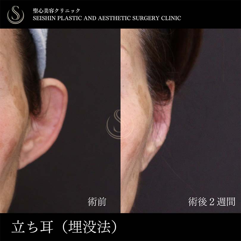 【60代女性・立ち耳を糸で改善】立ち耳修正（埋没法）（術後2週間） Before 