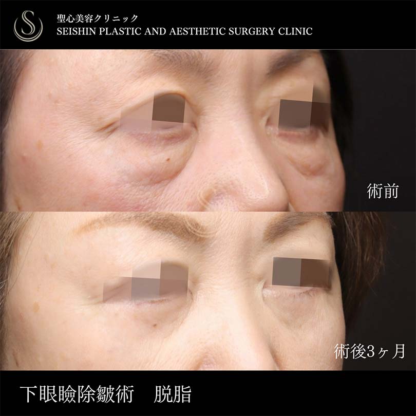 【60代女性・目のたるみを除皺術で改善】下眼瞼切開術/下眼瞼除皺術/ハムラ法（術後3ヶ月） After 