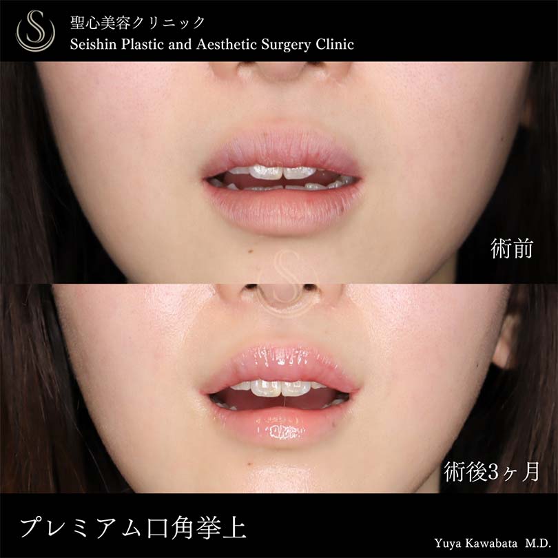 【20代女性・口角をキュッと自然に挙上】スマイルリップ（術後3ヶ月） Before 