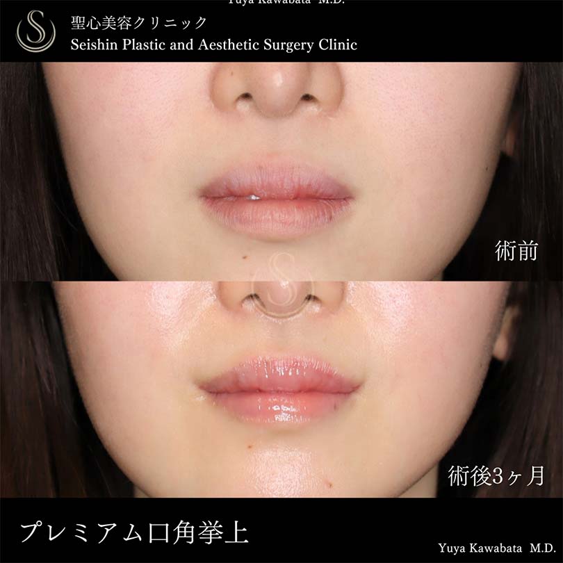 【20代女性・口角をキュッと自然に挙上】スマイルリップ（術後3ヶ月） After 