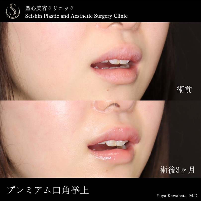 【20代女性・口角をキュッと自然に挙上】スマイルリップ（術後3ヶ月） After 