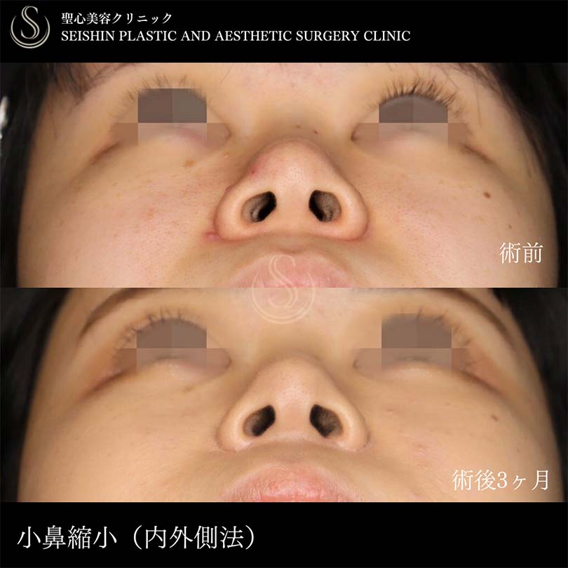【20代女性・鼻翼縮小で理想の忘れ鼻に】小鼻縮小（術後3ヶ月） After 