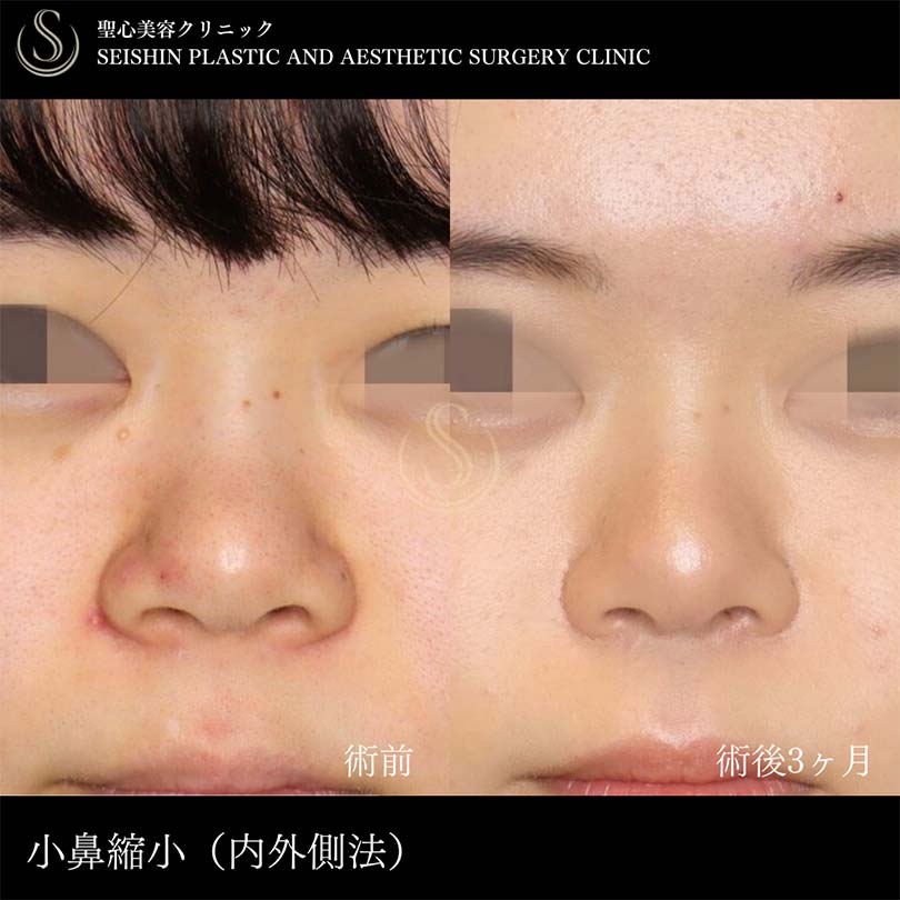 【20代女性・鼻翼縮小で理想の忘れ鼻に】小鼻縮小（術後3ヶ月） Before 