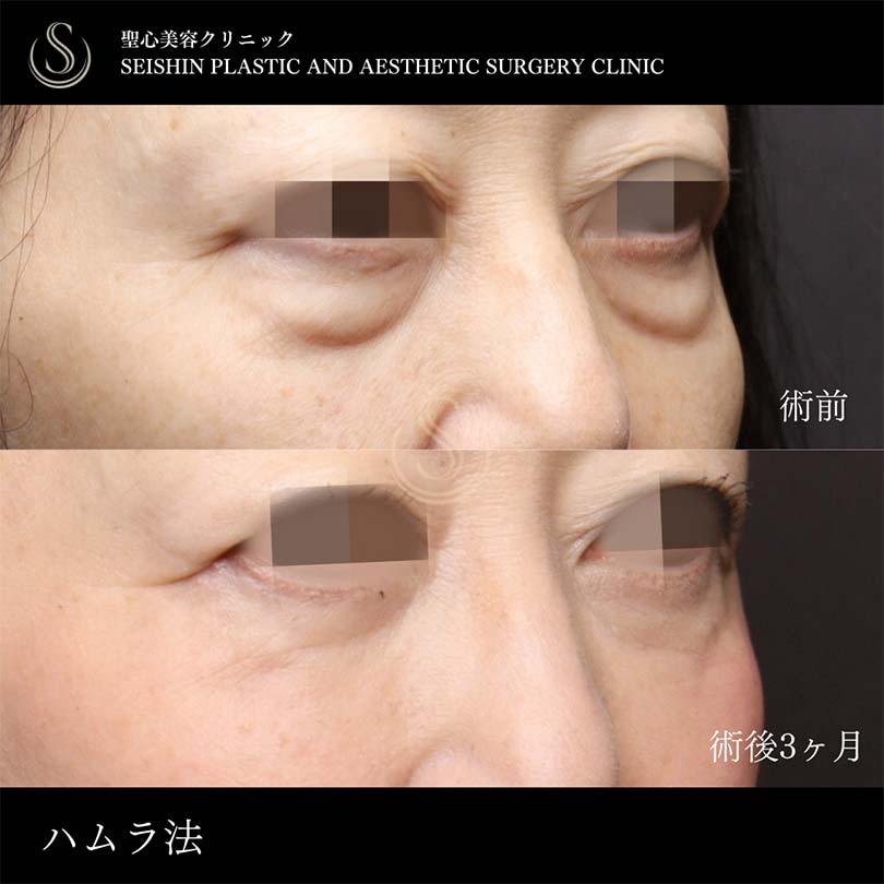 【50代女性・ハムラ法で大きめのクマをたるみをなくして解消】下眼瞼切開術/下眼瞼除皺術/ハムラ法（術後3ヶ月） After 