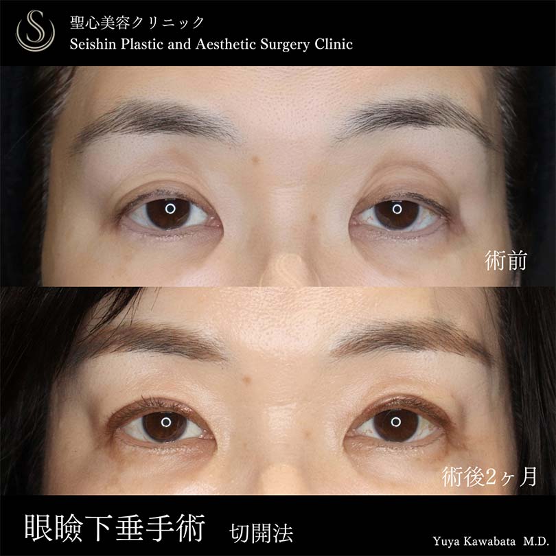 【50代女性・眼瞼下垂手術で目の開きを改善】眼瞼下垂（切開法/腱膜縫縮法）（術後2ヶ月） Before 