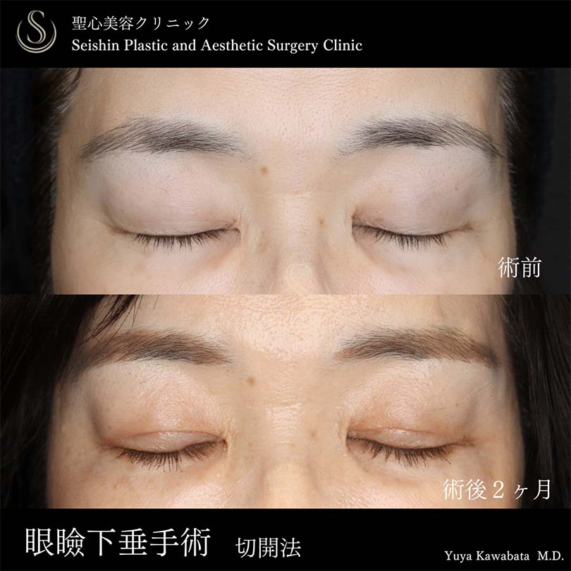 【50代女性・眼瞼下垂手術で目の開きを改善】眼瞼下垂（切開法/腱膜縫縮法）（術後2ヶ月） After 