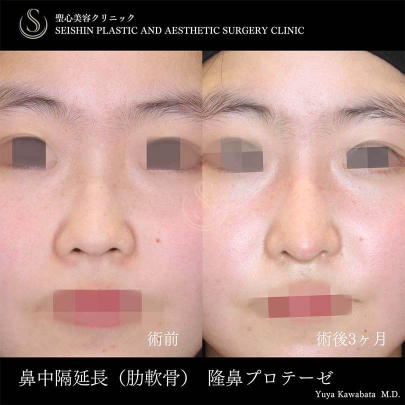 【10代女性・お鼻を自然に高く、ACRを整える】鼻中隔延長術、鼻尖形成（耳介軟骨移植）、プロテーゼによる隆鼻術（術後3ヶ月） After 