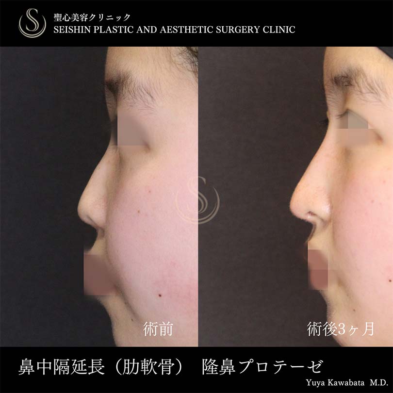 【10代女性・お鼻を自然に高く、ACRを整える】鼻中隔延長術、鼻尖形成（耳介軟骨移植）、プロテーゼによる隆鼻術（術後3ヶ月） Before 