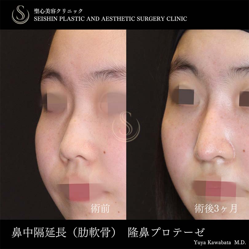 【10代女性・お鼻を自然に高く、ACRを整える】鼻中隔延長術、鼻尖形成（耳介軟骨移植）、プロテーゼによる隆鼻術（術後3ヶ月） After 
