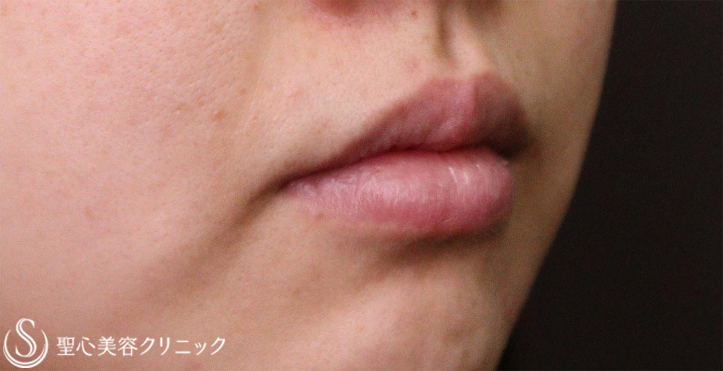 【20代女性・唇の厚み】口唇縮小術（術後3か月） Before 