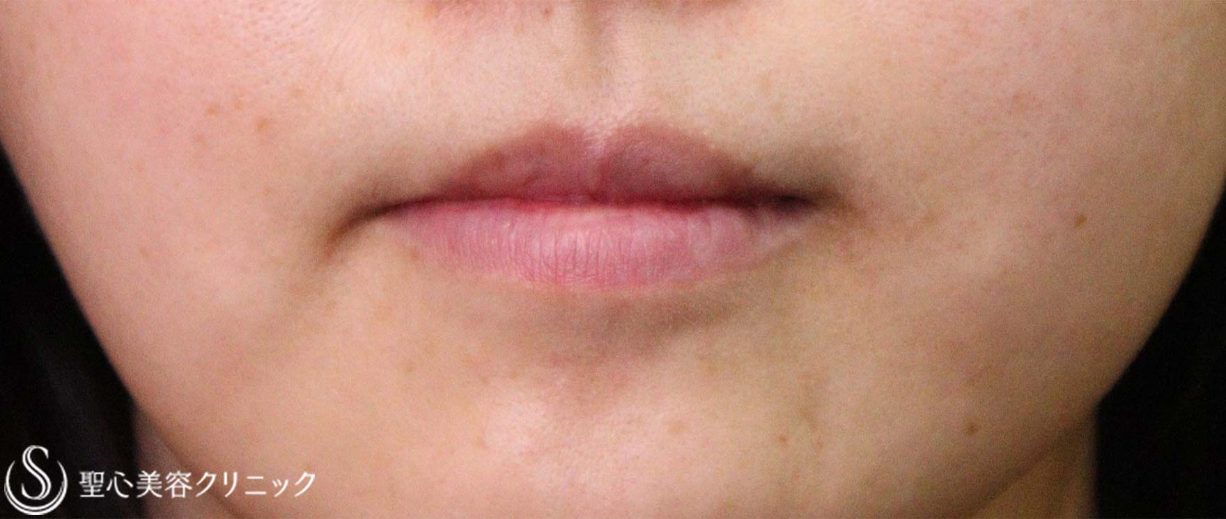 【20代女性・唇の厚み】口唇縮小術（術後3か月） After 