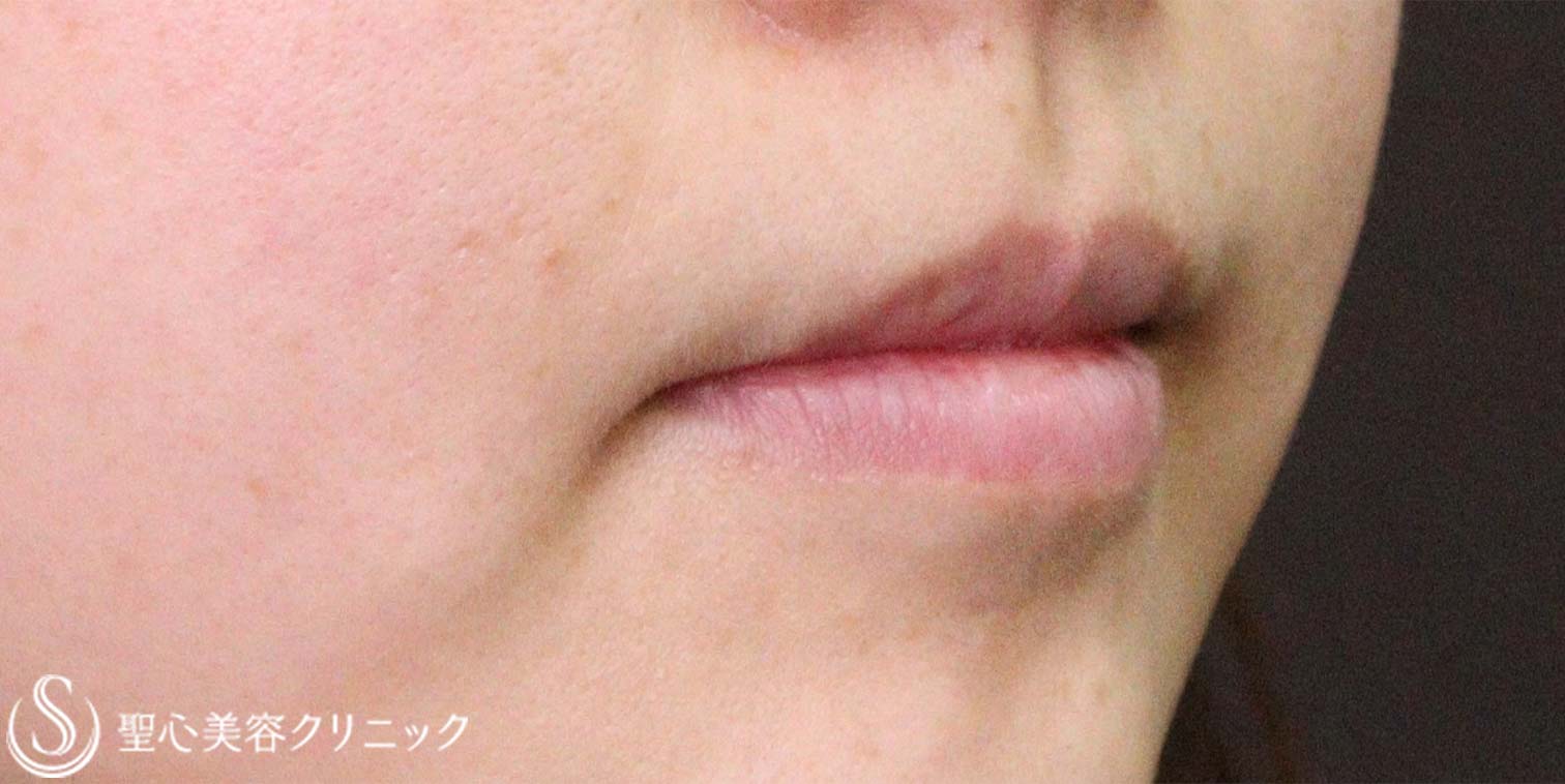 【20代女性・唇の厚み】口唇縮小術（術後3か月） After 