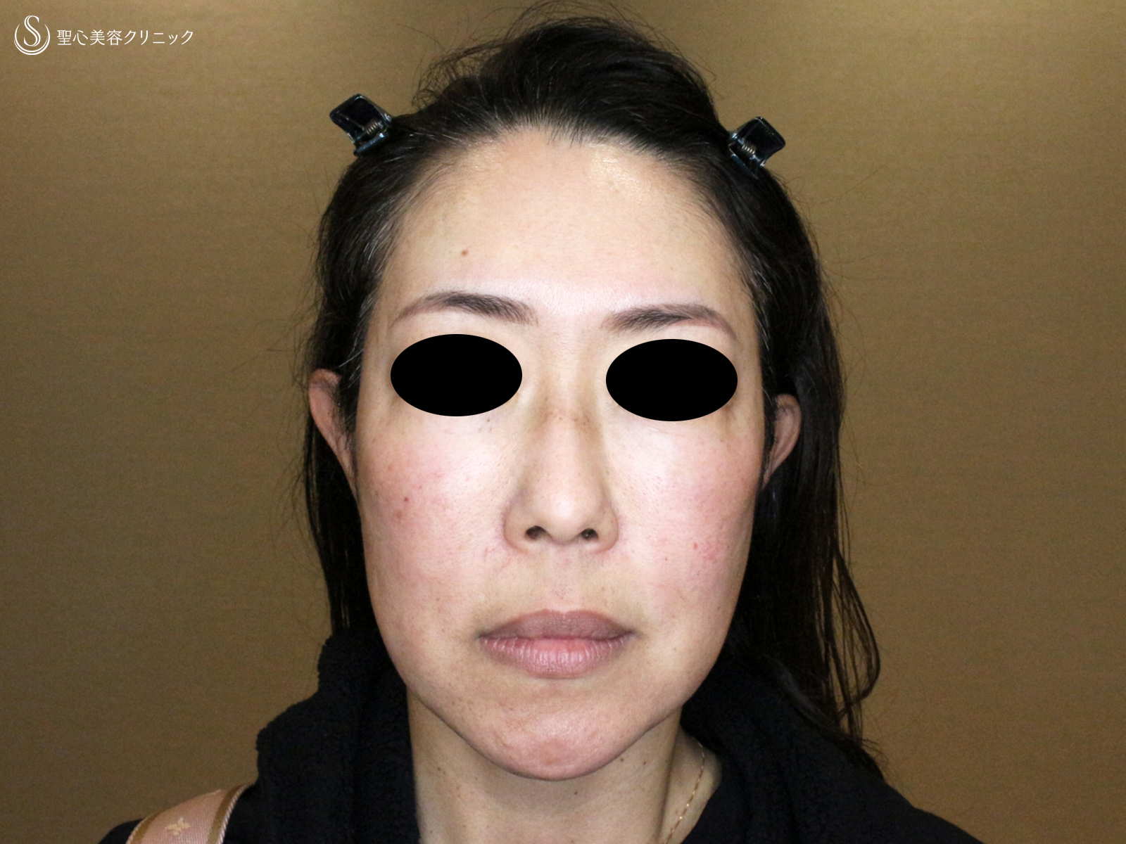 【54歳女性・最新リフト小顔マシン先行体験モニター】DENSITY「デンシティ」（1ヶ月後） Before 