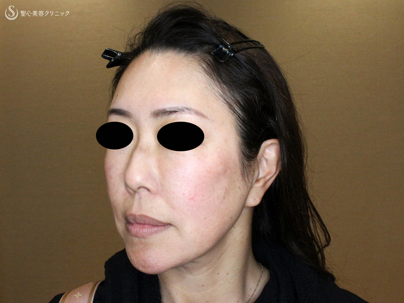 【54歳女性・最新リフト小顔マシン先行体験モニター】DENSITY「デンシティ」（1ヶ月後） Before 