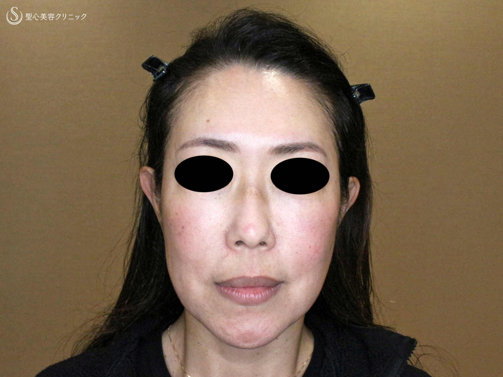 【54歳女性・最新リフト小顔マシン先行体験モニター】DENSITY「デンシティ」（1ヶ月後） After 