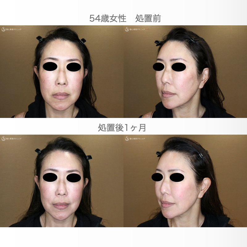 【54歳女性・最新リフト小顔マシン先行体験モニター】DENSITY「デンシティ」（1ヶ月後） After 
