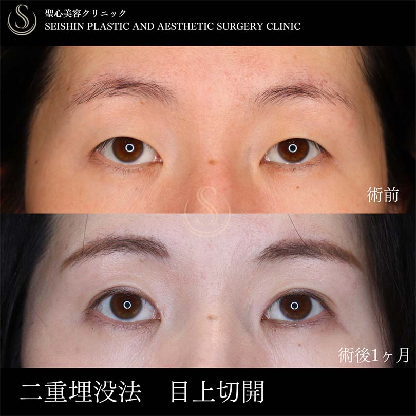 【20代女性・ナチュラルで印象的な目元に】二重術（埋没法）：マイクロメソッド+α、目上切開（術後1ヶ月） Before 
