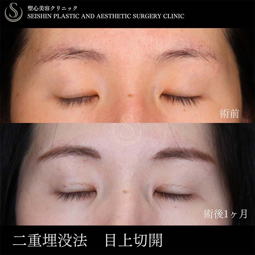 【20代女性・ナチュラルで印象的な目元に】二重術（埋没法）：マイクロメソッド+α、目上切開（術後1ヶ月） After 