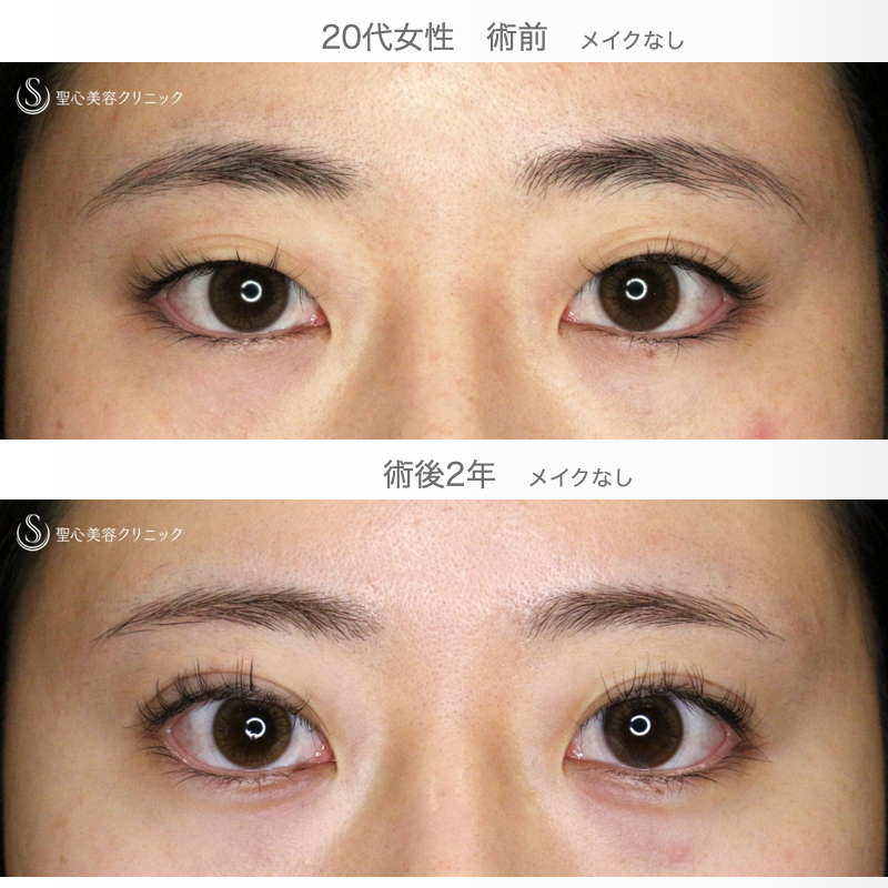 【20代女性・Mix型二重をつくる】マイクロメソッド+α 3点留め（術直後〜2年後） Before 