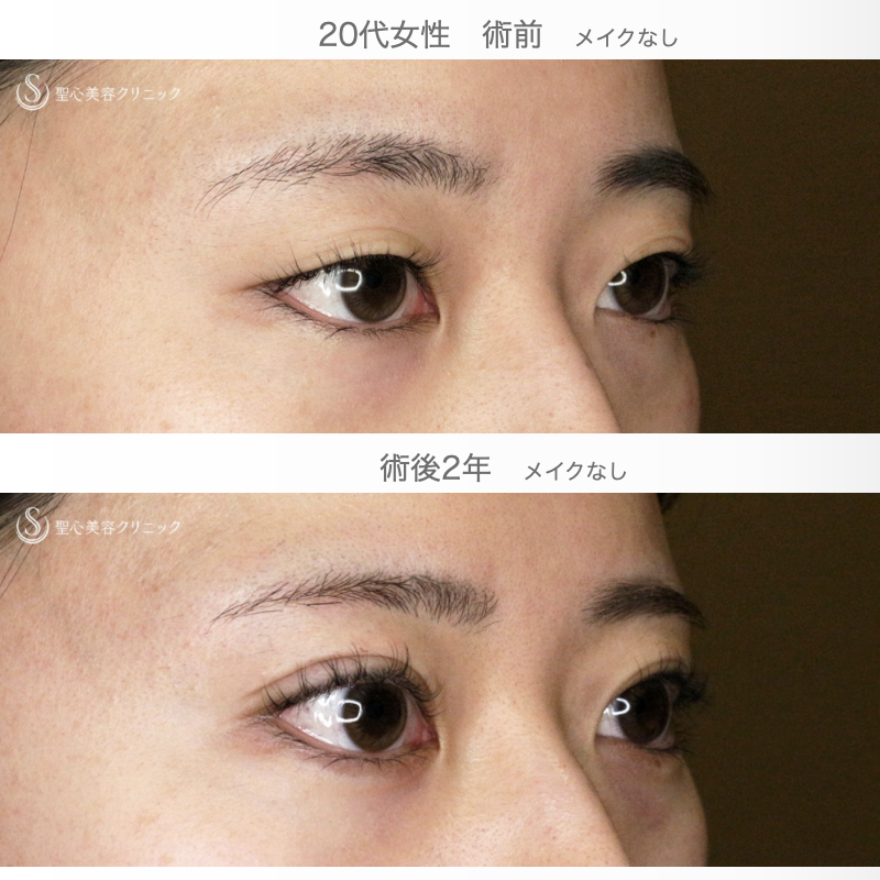 【20代女性・Mix型二重をつくる】マイクロメソッド+α 3点留め（術直後〜2年後） After 
