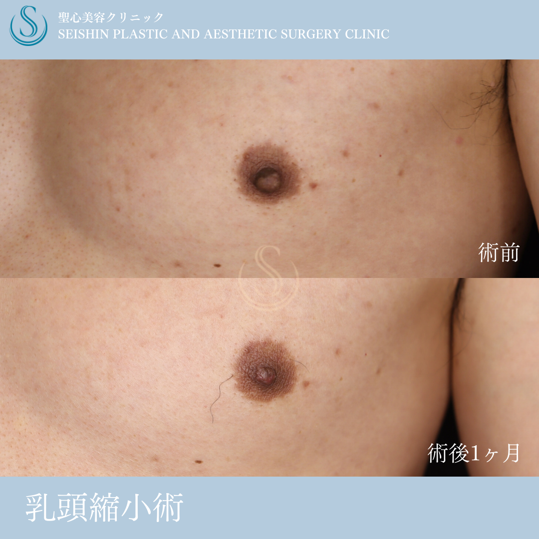 【50代男性・乳頭縮小でスッキリ】乳頭縮小（術後1ヶ月） Before 