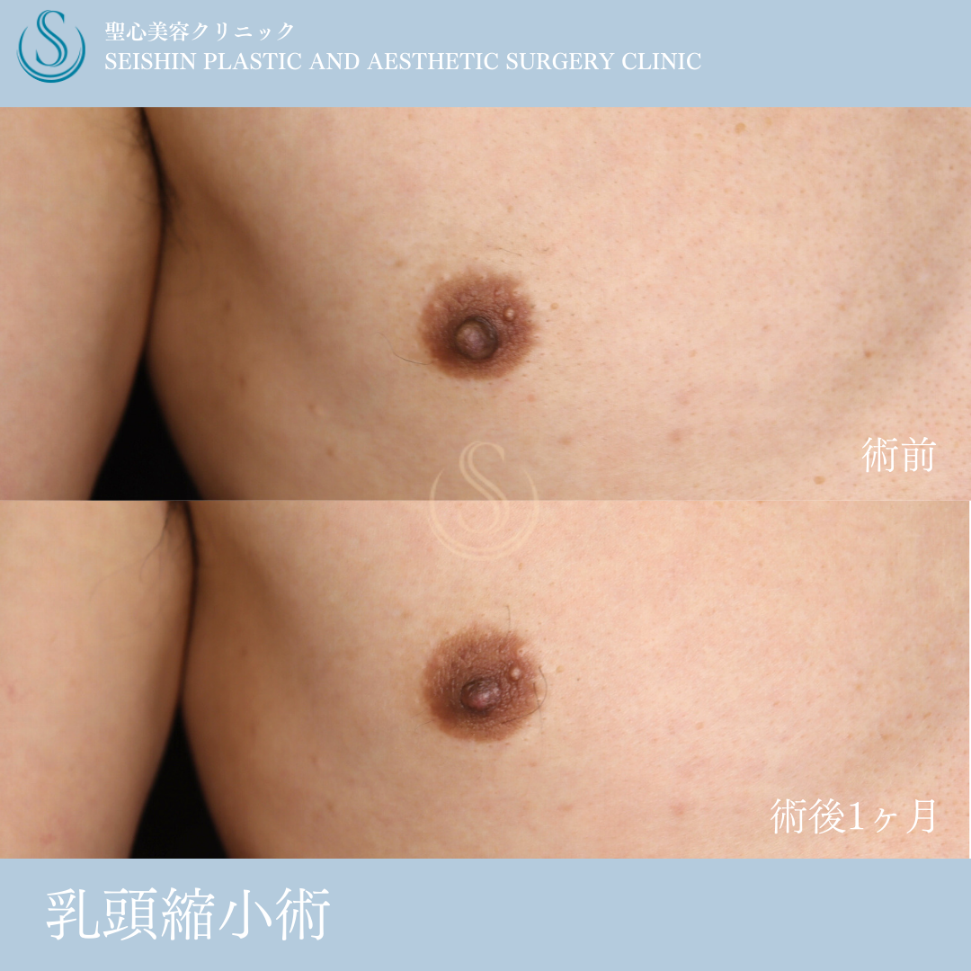 【50代男性・乳頭縮小でスッキリ】乳頭縮小（術後1ヶ月） After 