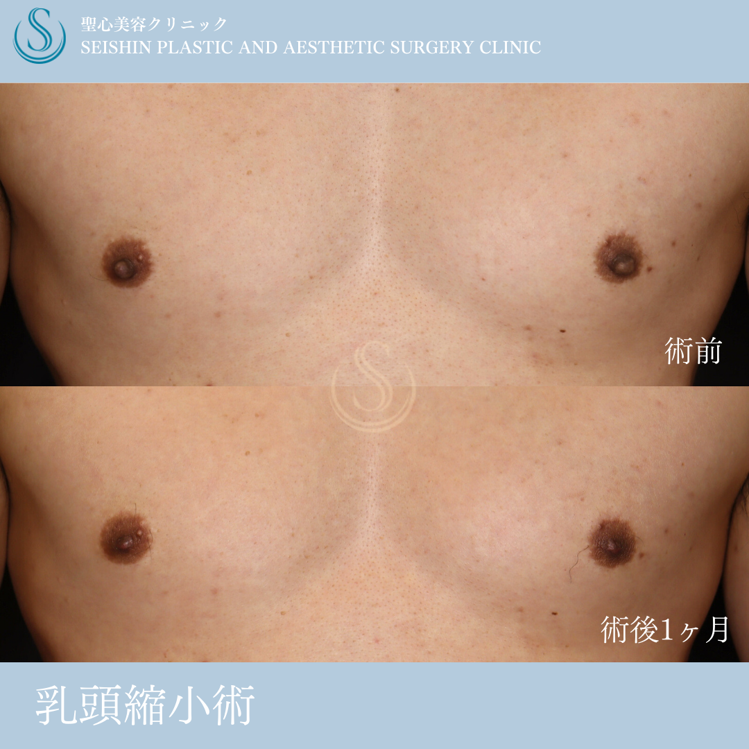 【50代男性・乳頭縮小でスッキリ】乳頭縮小（術後1ヶ月） After 