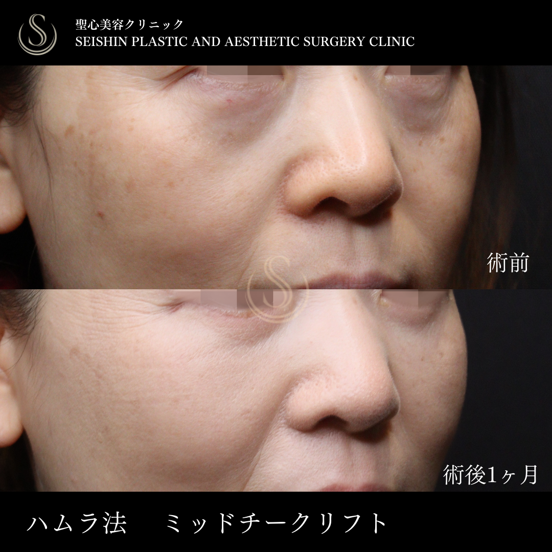 【50代女性・ミッドチークリフトで理想的なカーブに】下眼瞼切開術/下眼瞼除皺術/ハムラ法（術後1ヶ月） After 