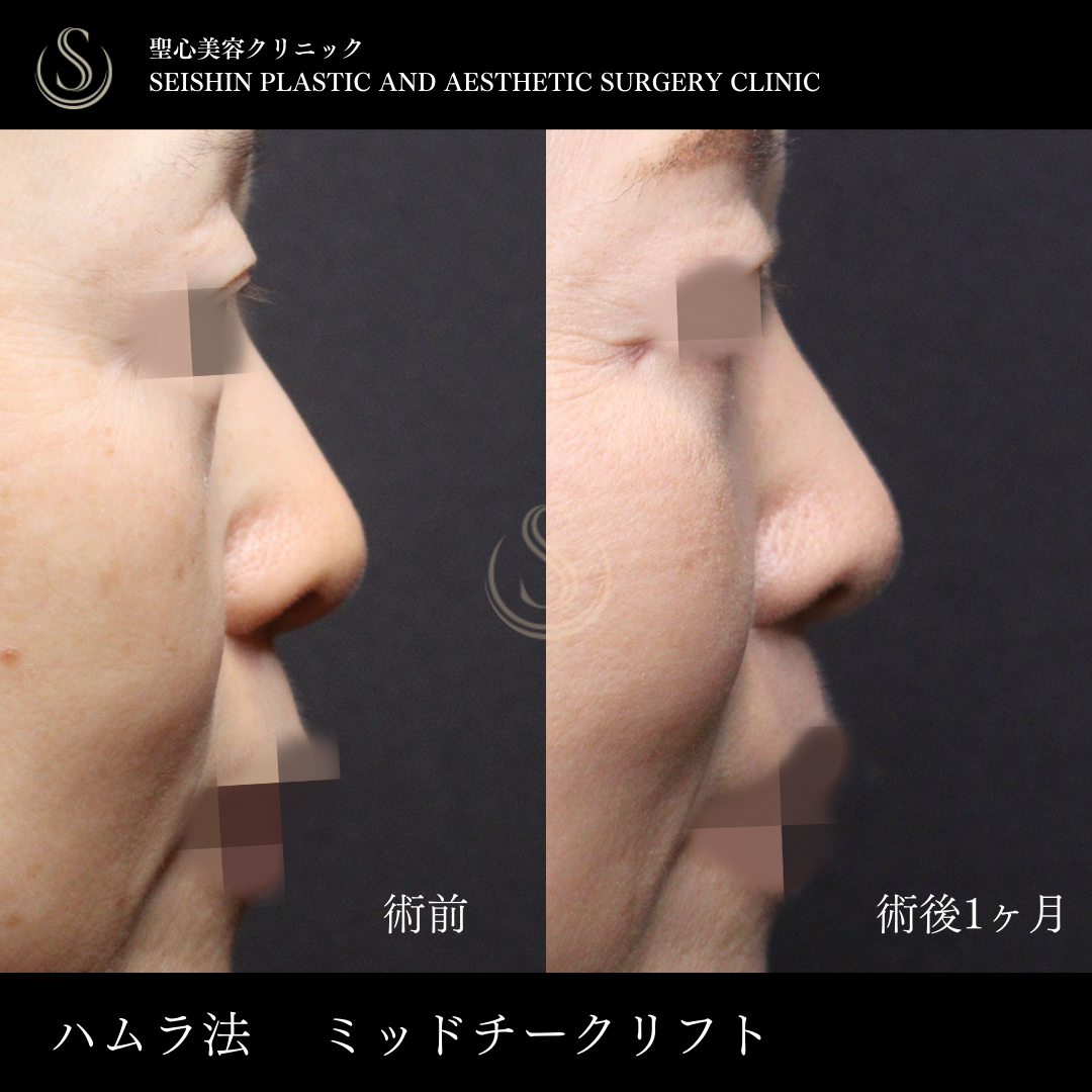 【50代女性・ミッドチークリフトで理想的なカーブに】下眼瞼切開術/下眼瞼除皺術/ハムラ法（術後1ヶ月） After 