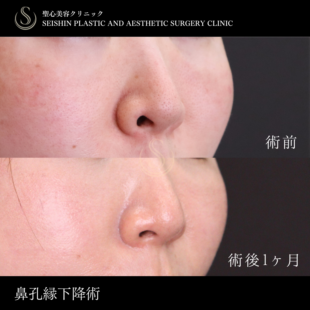【40代女性・鼻の穴を目立ちにくく】鼻孔縁下降術（術後1ヶ月） Before 